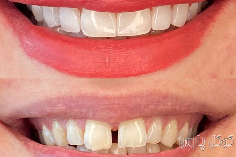 ایمپلنت دندان در نیاوران | کلینیک دندانپزشکی دکتر فاطمه اسمی