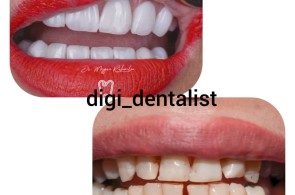 دندانپزشکی خلقانی | ایمپلنت دندان سعادت آباد