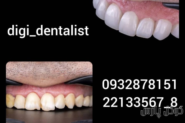 دیجی دنتالیست | ایمپلنت دندان سعادت آباد